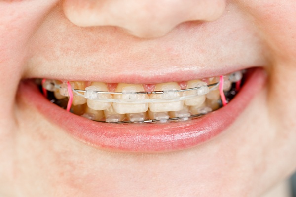 Clear Braces: A Discreet Solution For Crooked Teeth