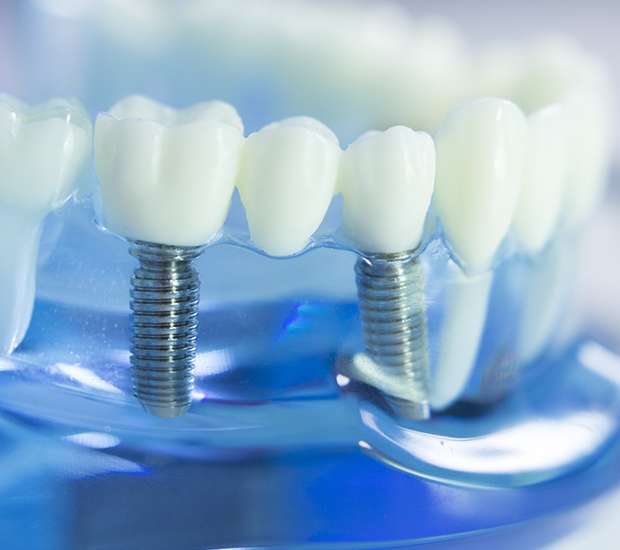 Cleveland Dental Implants