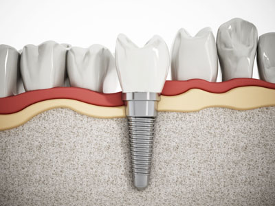 Signs That It&#    ;s Time To Replace Teeth Mini Implants