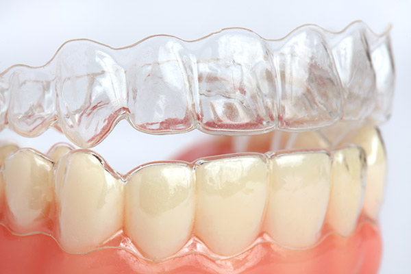 Learn The Truth About Clear Braces