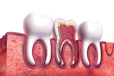 A Root Canal Dentist In Cleveland: Explaining The Basics Of A Root Canal