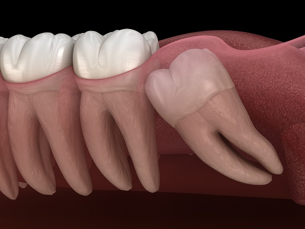 wisdom tooth extraction Cleveland, TX
